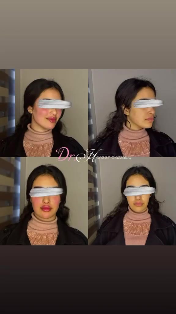 حنين العزاوي • الحسينية • فلر بوتوكس