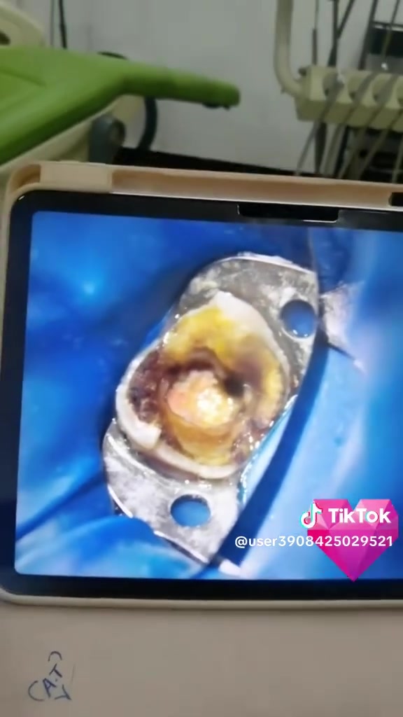 يعلن المجمع البركه الموجود في الأعظمية عن عروض من رخصت الادمن.  قسم أسنان. باطنيه جراحه عامه تحليلات سونار مجاني  1قسم الأسنان حشوات جذور ٧٥حشوه ضوئيه ٢٥تبيض ٢٥تنظيف ٢٥ زراعه ٢٠٠الف فقط. زاركون ٧٥سيراميك ٥٠
2قسم الليزر كل الجسم ٤٠الف منطقه الواحد ٥الف دينار فقط كل ٣جلسات الرابعه مجاني
3قسم الجراحه التحليلات  الشامله ٢٠سكر تراكمي ٨فيتامين d310 االعنوان الأعظمية شارع عشرين *********** كل جلسه أسنان هايدر فيشيل مجاني أو ليزر
