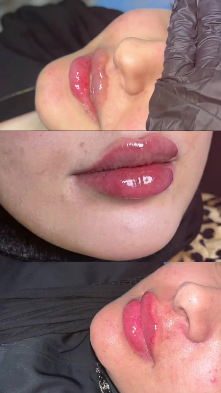 فلر • تحديد الفك • المحمودية