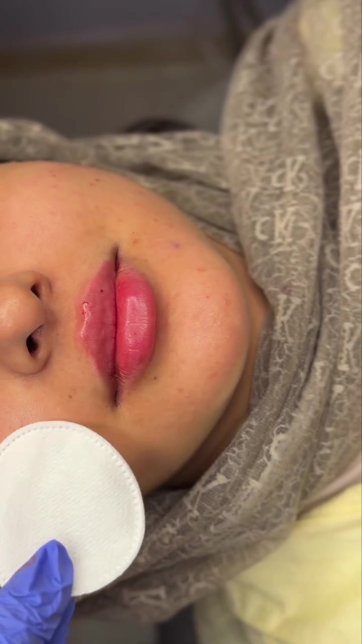 حقن فلر شفه وابرة السلمون للبشرة للجميلة ✨❤️

عيادة الدكتورة مروة محمد التميمي

🏥الديوانية العروبة-شارع المتحف-مجاور مطعم كودو كودو
📞رقم الحجز ***********

متوفر نظام التقسيط على الماستر كارد
