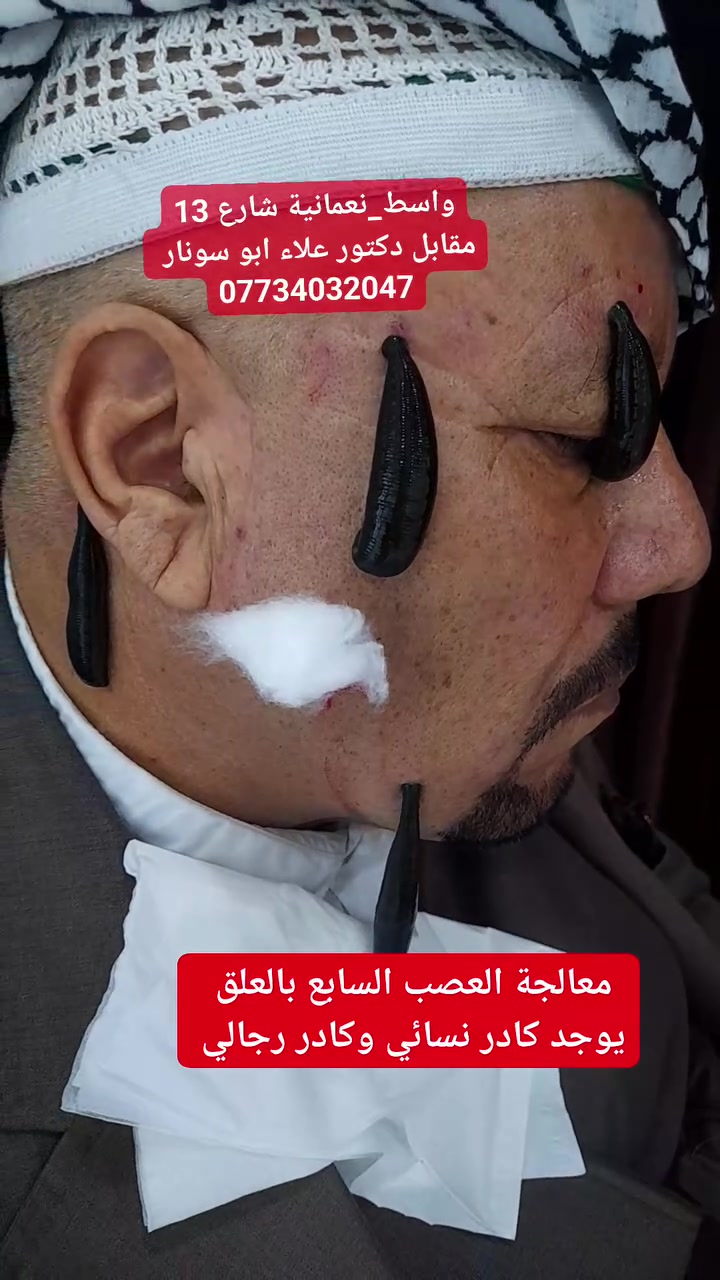 🩺 معالجة العصب السابع بالعلق الطبي

العلق الطبي يُستخدم ضمن جلسات علاجية تستهدف منطقة العصب السابع، بهدف معالجة أعراضه وتحسين الدورة الدموية في المنطقة.

📍العنوان محافظة واسط – قضاء النعمانية – شارع 13 مقابل دكتور علاء أبو سونار
👩‍⚕️ يوجد كادر نسائي وكادر رجالي
📞 للحجز والاستفسار: ***********
 المصطفى للحجامة و الطب البديل 
ابو علي الشمري 
#معالجة_العصب_السابع_بالعلق_الطبي #العلق_الطبي #الحجامة_النسائية #الحجامة #النعمانية #واسط
 #الجميع #متابعين #اشارة @إشارة
