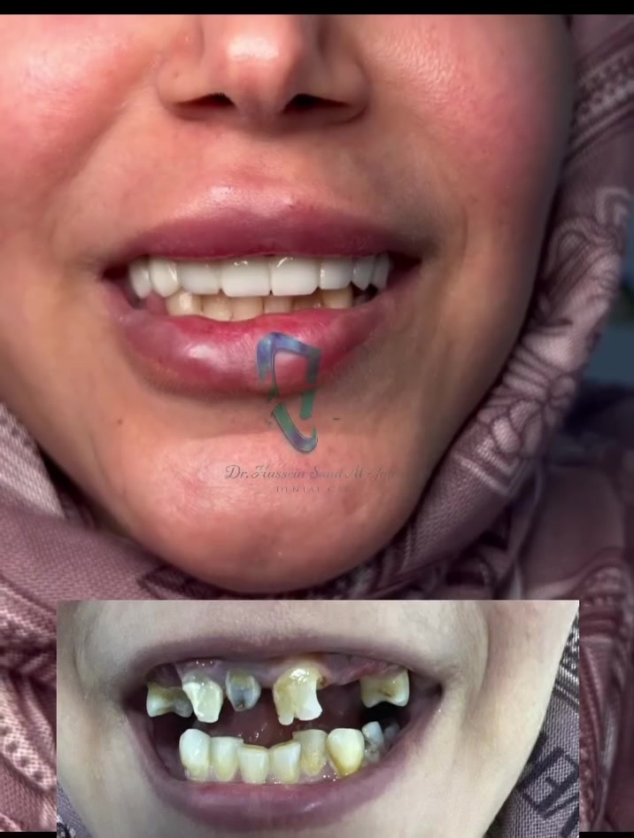 ✨ مو بس ابتسامة… هي فرحة أم بشوفة بنتها تبتسم بثقة ❤️
من أجمل اللحظات بعملنا هي اللحظة اللي نشوف بيها فرحة الأم وهي تشوف التغيير بابتسامة بنتها 🥰
ابتسامة أجمل، ثقة أكبر، وفرحة ما تنوصف بالكلام 🤍
ابتسامتكم هي أجمل نتيجة لعملنا. 🦷✨
ارقام الحجز 
***********
***********
📍شارع الاطباء-مجمع القمةالطبي- مقابيل التربية القديمة-عيادةدكتور 
حسين سعد الجابري
