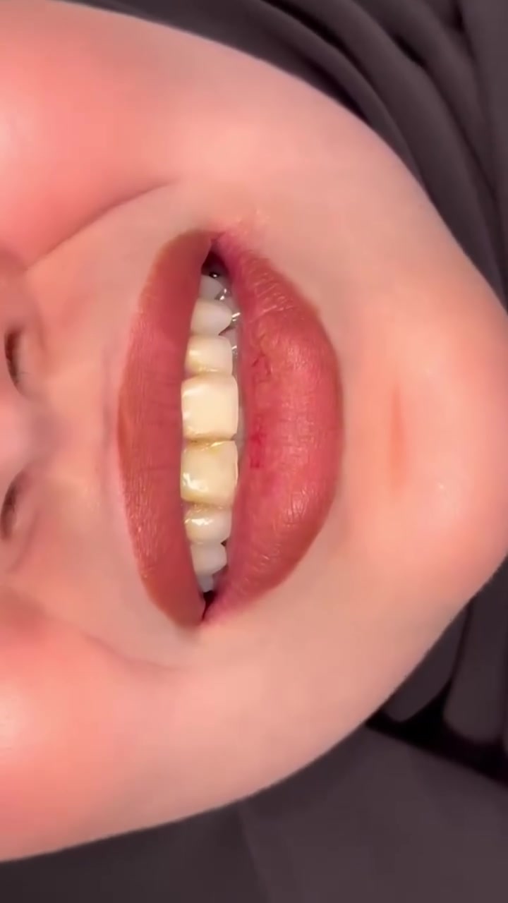 🦷 لا تخلي مشاكل الأسنان تأثر على ابتسامتك 🤍
اهتم بأسنانك، وعالجها بوقت مناسب، وخلي ابتسامتك دائماً بأجمل صورة ✨

مركز سما المناذرة لطب الأسنان
نهتم بتفاصيل ابتسامتك من أول خطوة إلى النتيجة الأخيرة 🌸

العنوان / النجف الاشرف _ المناذرة _ الشارع العام _ قرب مستشفى
 المناذرة _عمارة الحاج ابو نبيل جانب صيدلية الأصالة
 للحجز والأستفسار / ***********
الساعه 9:00 صباحا الساعه 1:00 ظهرا من الساعه 3:30 ظهرا الى الساعه 9:30 ليلا ًَ
#تقويم_اسنان 
#زراعة_الاسنان 
#ابتسامة_هوليود 
#حشوات_تجميلية 
#هاشتاك
