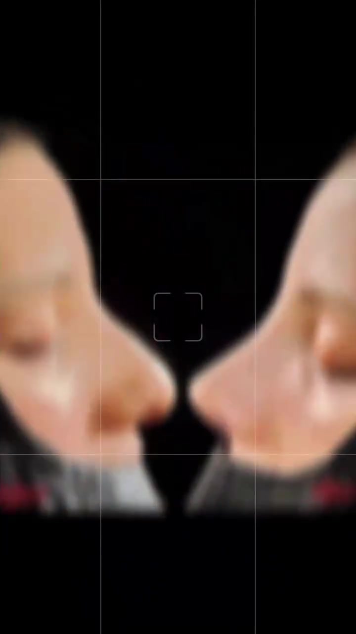 ✨ بحثت عن طبيب تثق به… ومنحتنا ثقتها ✨
كانت أمنيتها أن تحصل على أنف طبيعي ومتناسق مع ملامح وجهها، وكانت النتيجة كما أحبت وتمنّت ❤️
في تجميل الأنف الوظيفي والتجميلي، نحرص على تحقيق التوازن بين الشكل الجميل والتنفس الجيد، مع الحفاظ على نتيجة طبيعية تناسب كل وجه.
👨‍⚕️ د. سفيان مناور السلطان
اختصاص جراحة الأنف والأذن والحنجرة
متخصص في جراحة الأنف الوظيفية والتجميلية
📍 الموصل – حي المثنى
مجمع الأزل الطبي – مقابل مستشفى صحة المرأة
📞 للحجز والاستفسار:
***********
✨ فحص دقيق… تخطيط مدروس… ونتيجة طبيعية
