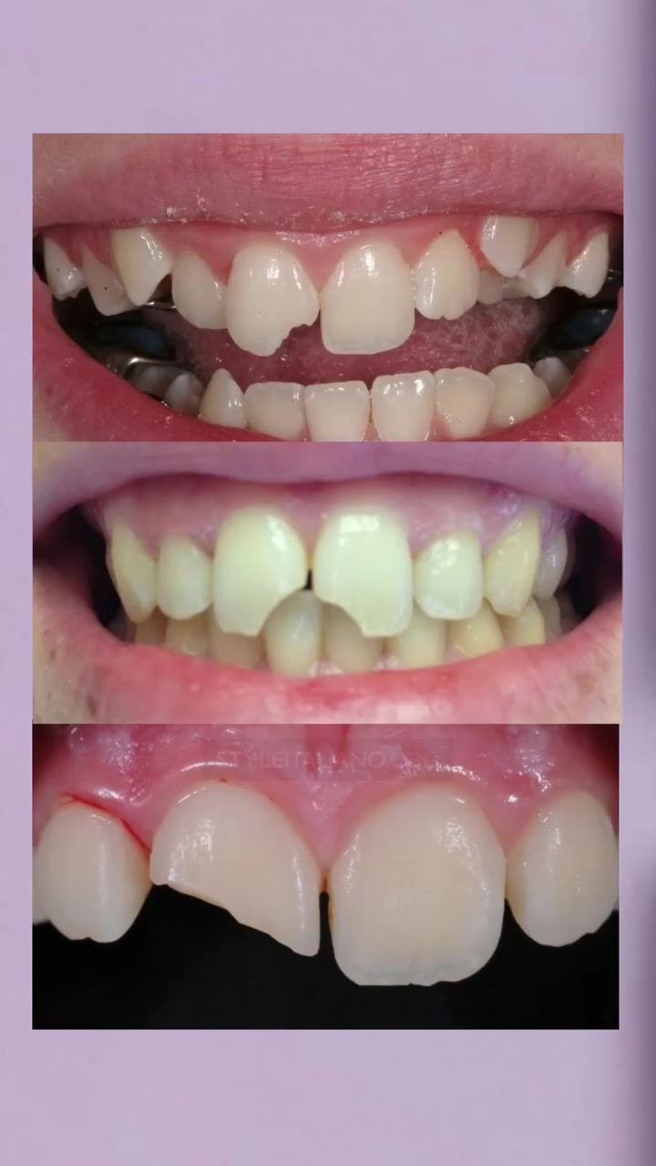 طقم اسنان جزئي لل فاقد عدد من الاسنان
باسعار رمزية 

📞 واتساب :
 ***********
⭕️بعيادات جامعة كلكامش
📍العنوان : الدورة / ابو دشير / جامعة كلكامش
