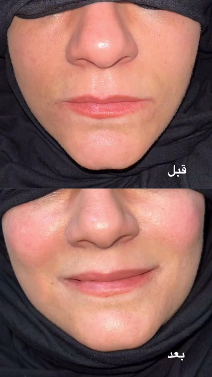 ✨ مركز الشرق الأوسط الطبي الخيري
💗 قسم التجميل

فلر الوجنات ✨

إطلالة أكثر تناسقًا، وملامح أجمل بإطلالة طبيعية وأنيقة 💕
لمسة ناعمة تبرز جمال وجهك وتزيده إشراقًا.

📍 العنوان:
ذي قار – قضاء الشطرة – مدخل حي المعلمين – قرب صورة السيد الحكيم

📞 للحجز والاستفسار:
***********
