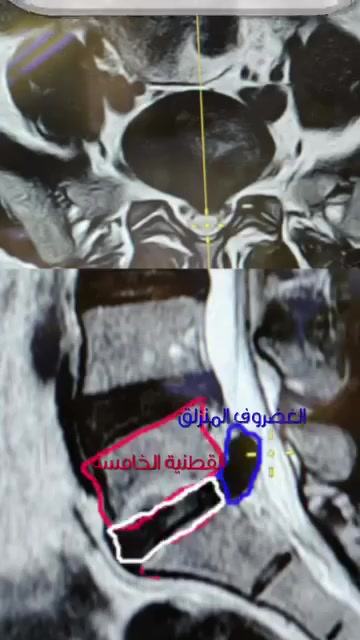 د. سرمد زنكنه • انزلاق غضروفي قطني • الحويجة