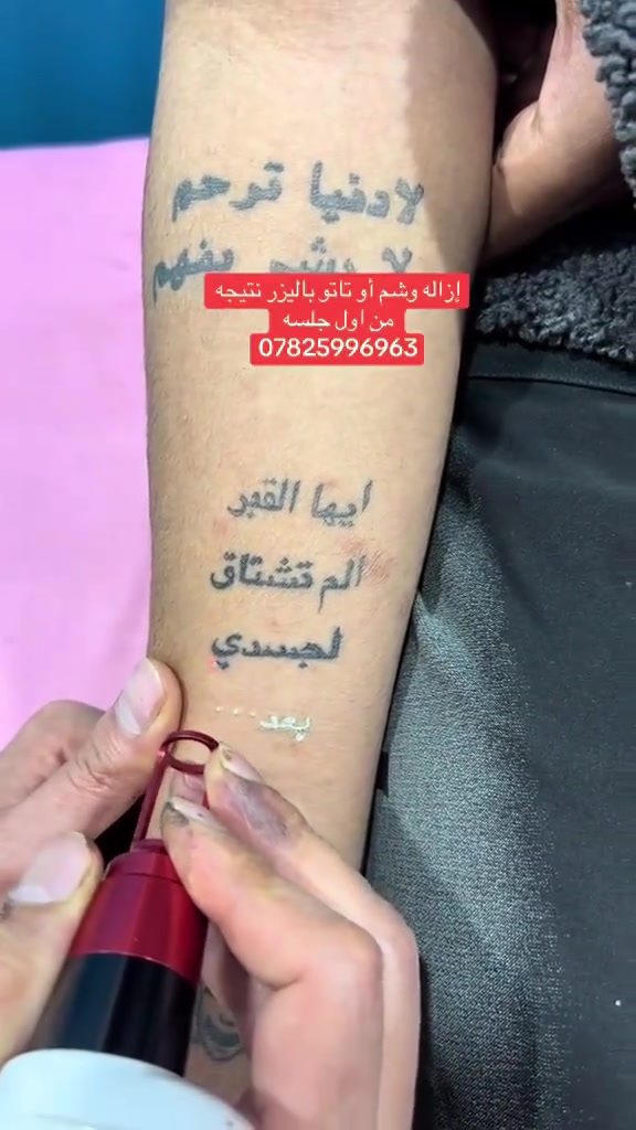 ازاله الوشم باليزر جلسه سعر الجلسه يحدد بعد المعاينه 
راسلنا خاص بصوره الوشم للاستفسار عن  الازاله  *********** العنوان الناصريه الاصلااح مقابيل فلكه @إشارة
