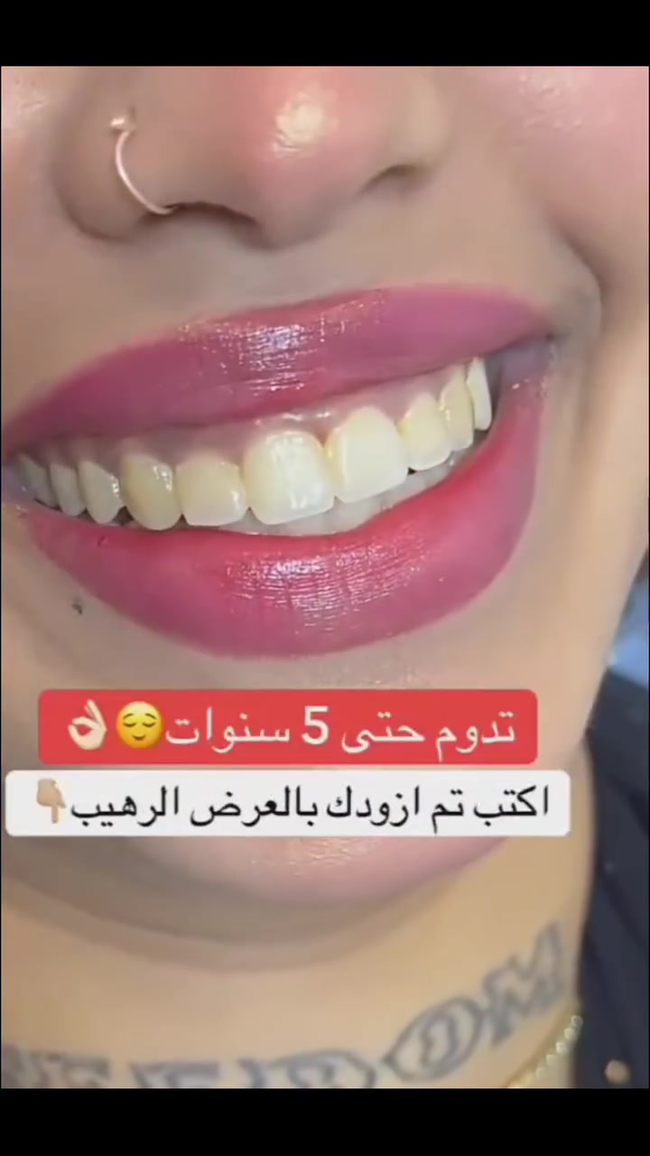 من حاب يغير ابتسامته بدون برد و ٦٠ دقيقه فقط
وبنظام الاقساط المريح
الاتصال:0772504422او***********
