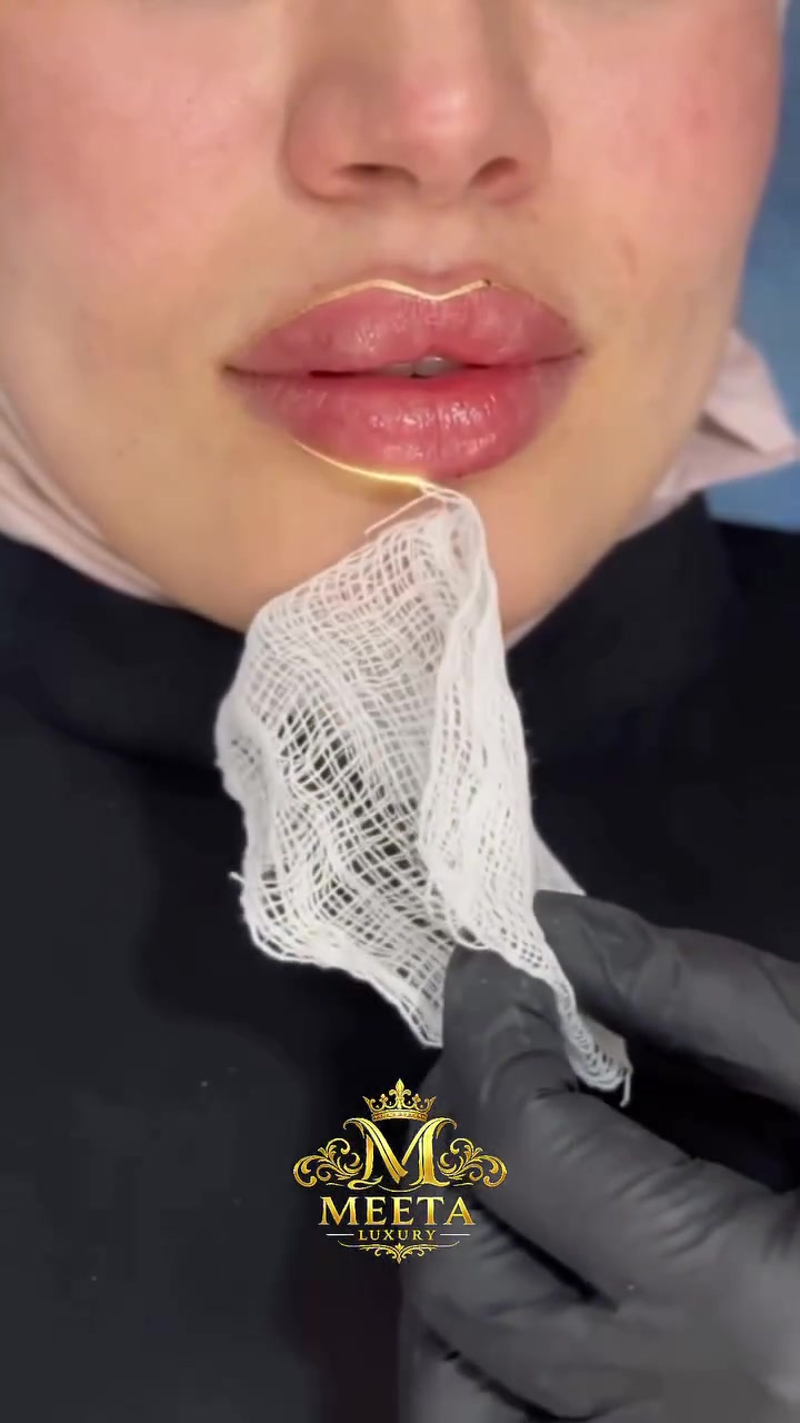 فيلر • ميتا لاكجري • الموصل حي البلديات