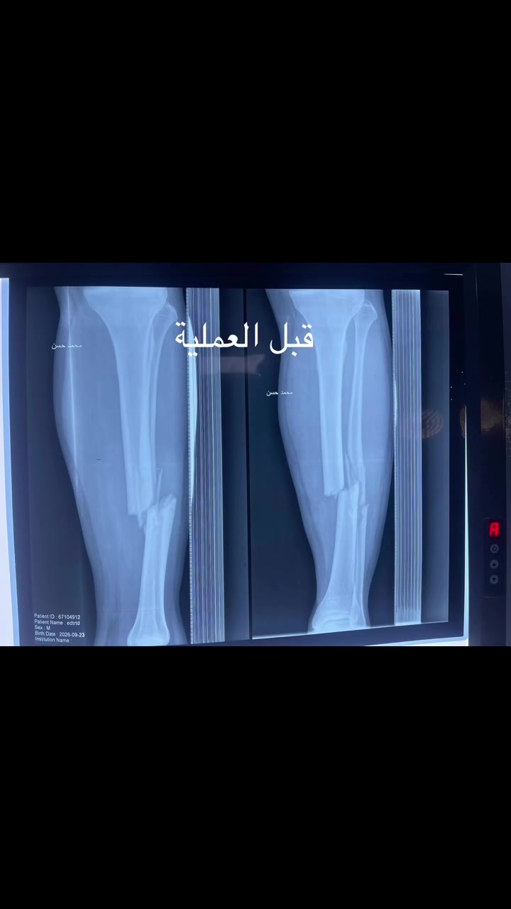 د. حيدر فرعون • جراحة عظام • مجمع الالتزام الطبي