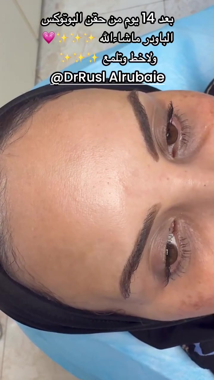 شنو رأيكم بالنتائج ؟
هاي نتيجة ما انزل اي مادة بالعياده اله واثقه منهه 💯  ومجربتها اني شخصياً !!💗💗 اهم شي المراجعات يطلعون راضيين وكل مراجعاتي جميلات 

بمناسبة قدوم موسم الاعراس👰🏻‍♀️👰🏻‍♀️ سويتلكم بكجات خاصه للعروسات والي عدهم مناسبات بكج متكامل من تنظيف بشرة الى حقن ابر نضاره كلشي بي للاستفسار والحجز مراسلتنا واتساب***********

اوعلى صفحة الانستكرام https://www.instagram.com/p/DbWWdUhsNAt/?igsh=Z2EwenVjcm5rOXFu

او صفحة الفيسبوك DrRusl Alrubaie💗👰🏻‍♀️👰🏻‍♀️👰🏻‍♀️
