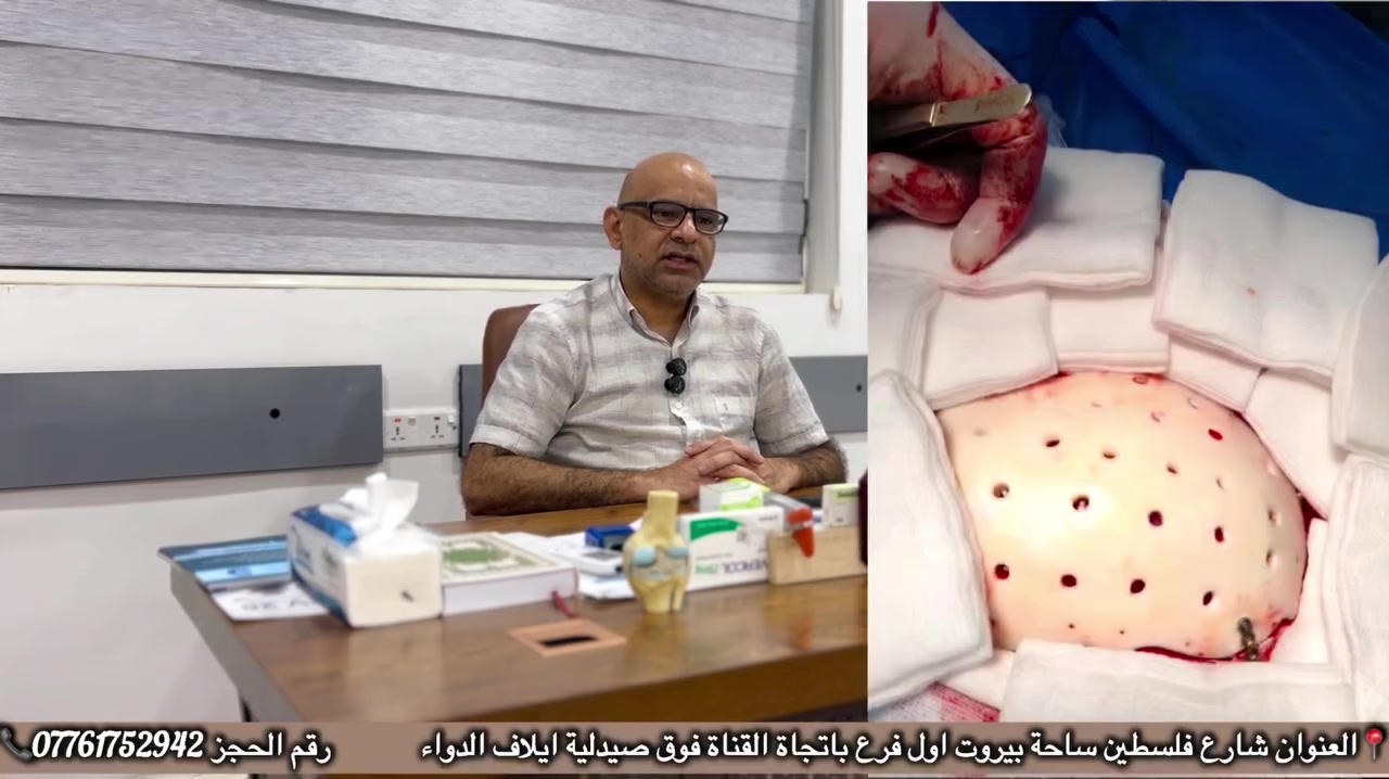 ✨ رحلة أمل وعزيمة.. نجاح عملية معقدة لترميم الجمجمة بعد حادث تعرّض له شاب في مقتبل العمر 🧠💪
بفضل الله وتوفيقه، وجهود الدكتور الاستشاري ميثاق علي أحمد 🩺 (استشاري جراحة الدماغ والأعصاب والعمود الفقري، وعلاج الصداع، الشقيقة، ونوبات الصرع)، تم بحمد الله إنهاء معاناة شاب يبلغ من العمر ٢١ عاماً 👦 تعرّض لحادث أليم 🚗💥.
📋 تفاصيل الحالة والتدخل الجراحي:
 🚨 الإصابة: حضر المريض وهو يعاني من نزف تحت الأم الجافية مع تهشم في أجزاء من الجمجمة نتيجة الحادث.
 ⚡ المرحلة الأولى: أجريت له فوراً عملية طارئة تكللت بالنجاح لإيقاف النزف وإنقاذ حياته، مع استئصال الجزء المهشم من الجمجمة لحماية الدماغ.
 ⏳ المرحلة الثانية: بعد مرور ٣ أشهر من التعافي والمتابعة المستمرة، أجرى الدكتور ميثاق علي أحمد العملية الثانية لتعويض عظم الجمجمة المفقود وإعادة الشكل والوظيفة الطبيعية للحماية.
🙏 ولله الحمد والمنة، تكللت العملية بالنجاح التام، وعاد المريض لممارسة حياته بصحة وعافية. 🌟
📍 عنوان العيادة:
شارع فلسطين - ساحة بيروت - أول فرع باتجاه القناة - فوق صيدلية إيلاف الدواء 🏥
📞 للحجز والاستفسار:
*********** 📲#العراق #اكسبلور #اكسبلور_فولو #ترند #بغداد
