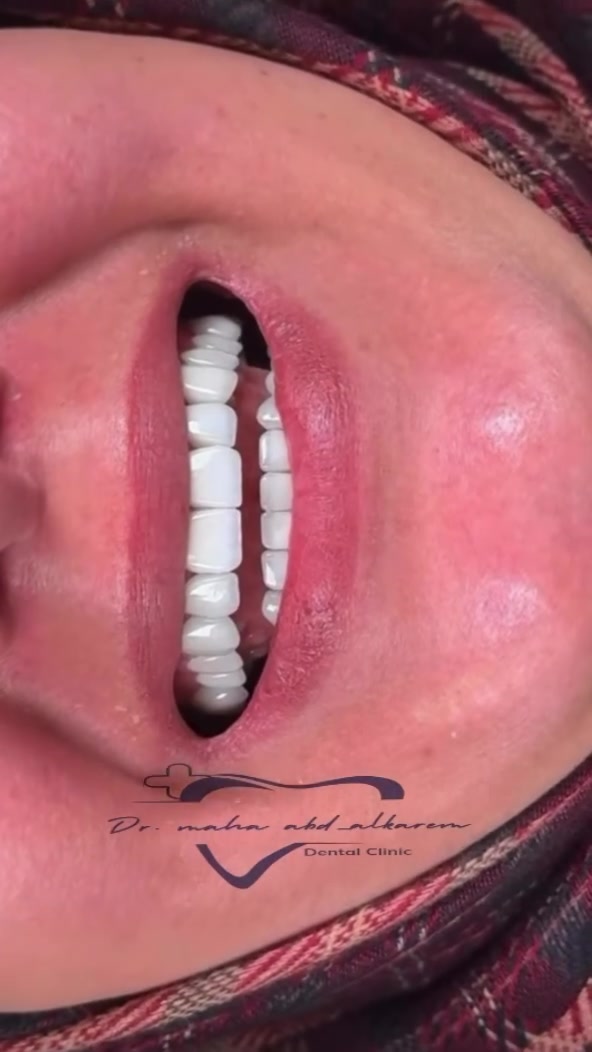 التغير الشامل 🔥🦷

هوليود سمايل للفكّين علوي وسفلي نوع زيركون 
بلون ثلجي حسب طلب مراجعة 
.
.
.
عنوان العيادة ..
الرمادي _شارع المستودع _اول فرع يمينا 
مجمع زهرة اليقطين الطبي قرب كراج التاميم
الطابق الثاني 
للحجز والاستفسار:  ***********
