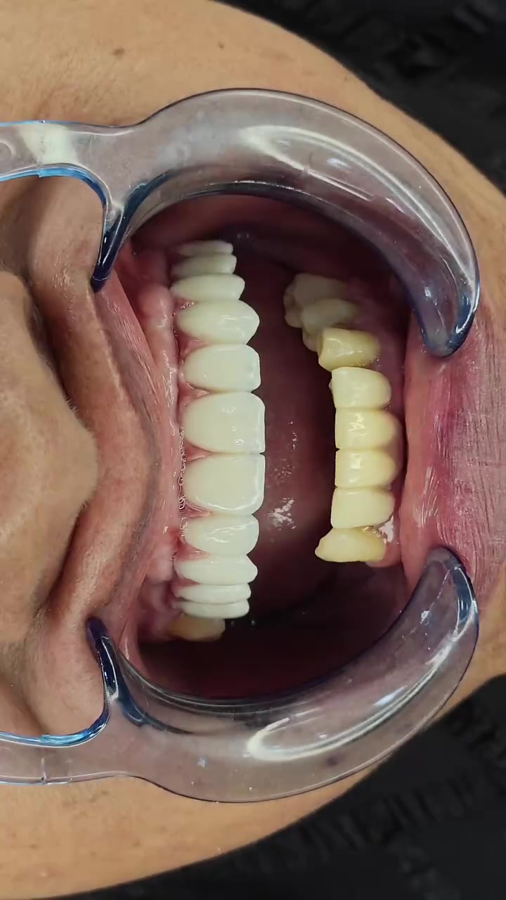 🦷 زراعة الأسنان… استعادة للابتسامة والثقة
فقدان الأسنان لا يعني أن تتخلى عن ابتسامتك أو راحتك في الأكل والكلام.
زراعة الأسنان توفر حلاً ثابتاً وطبيعياً لتعويض الأسنان المفقودة، مع إمكانية استعادة وظيفة الأسنان ومظهر الابتسامة.
#الدكتور_علي_الغريفي 
#شارع_الالف 
#مجمع_المرتضى 
***********
