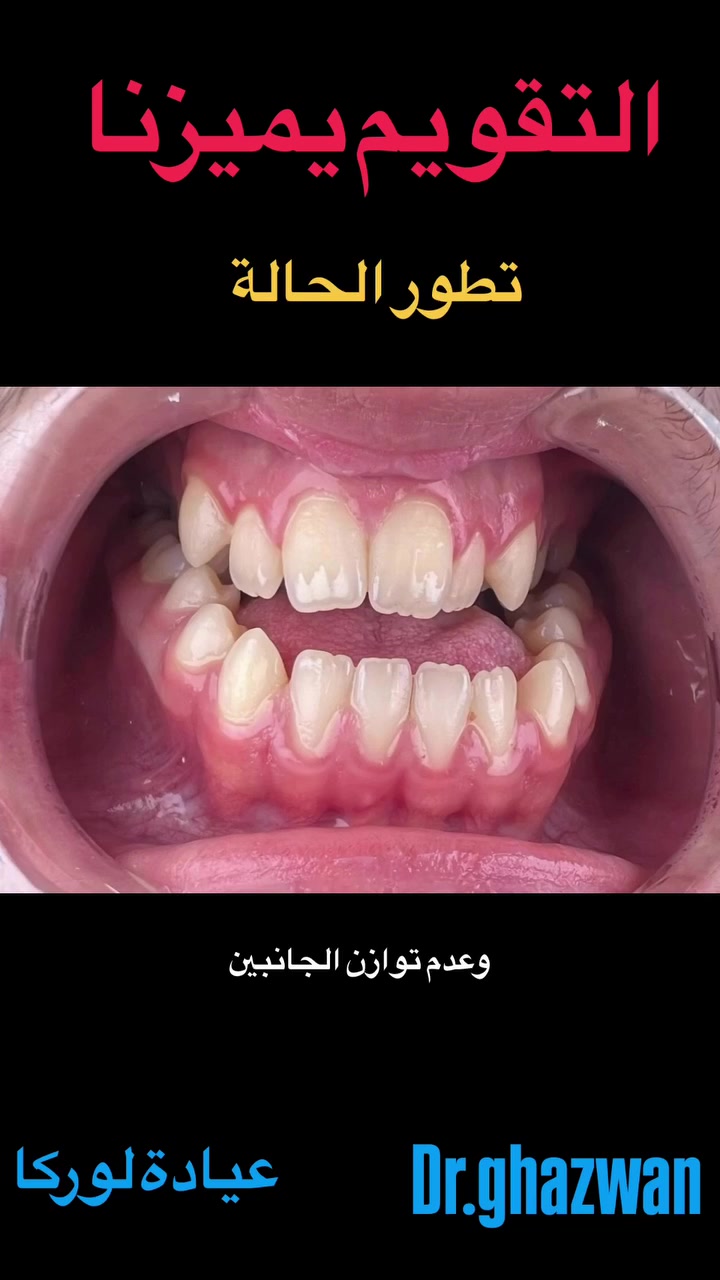 التقويم يميزنا احد اعقد و اصعب الحالات تقدم الفك السفلي و تراجع العلوي يعاني من مظهر خارجي غير متناسق و عدم توازن الجانبين و عدم القدرة على تقطيع الطعام و صعوبة في الكلام و انزعاجات مستمرة … علاج جميع الحالات الصعبة و المستعصية نتائج مضمونة خبرة طويلة في مجال الحالات الصعبة ابتسامة مثالية اسعار مناسبة بالتقسيط المريح… دكتور غزوان مزهر بغداد الكرخ نفق الشرطة بداية شارع الاطباء عيادة لوركا فوق صيدلية كنز النفق متوفر واتس *********** #تقويمالأسنان #العضة_المفتوحة #تقدمالفكالسفلي #العضة_المعكوسة #تغليف_الاسنان_الزاركون
