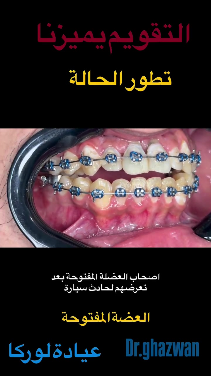التقويم يميزنا احد اعقد و اصعب الحالات العضة المفتوحة و تعرض المريض لحادث انقلاب دراجة و تكسر عظام الفكين و بعد الشفاء قدم للعيادة لتكملة العلاج …. علاج جميع الحالات الصعبة و المستعصية نتائج مضمونة خبرة متميزة دقة في العلاج خبرة ضمن الحالات المستعصية و المعقدة و النادرة … دكتور غزوان مزهر بغداد الكرخ نفق الشرطة بداية شارع الاطباء عيادة لوركا فوق صيدلية كنز النفق متوفر واتس *********** #تقويمالأسنان #تقويم_الأسنان_قبل_وبعد #العضة_المعكوسة #العضة_المفتوحة #تقدم_الفك_العلوي_السفلي @تغليف_الاسنان_الزاركون
