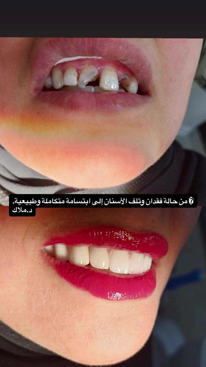 � من حالة فقدان وتلف الأسنان إلى ابتسامة متكاملة وطبيعية.

في هذا العمل تم:
✅ تقييم الحالة ووضع الخطة العلاجية المناسبة
✅ زراعة الدعامات (المرابط) بدقة عالية
✅ تركيب الأسنان النهائية بأفضل الخامات
✅ استعادة الشكل الجمالي والوظيفة الطبيعية للأسنان

🌟 النتيجة:
ابتسامة طبيعية، مظهر أجمل، وثقة أكبر بالنفس.

نحرص في عيادة ملاك على تقديم أحدث التقنيات وأفضل الحلول العلاجية والتجميلية للحصول على نتائج تدوم وتمنحك الراحة والرضا.

📍 عيادة ملاك لطب وتجميل الأسنان
📞 ***********

#زراعة_الأسنان #تركيبات_الأسنان #تجميل_الأسنان #ابتسامة_هوليود #عيادة_ملاك طب_الأسنان ابتسامة_جميلة العر
