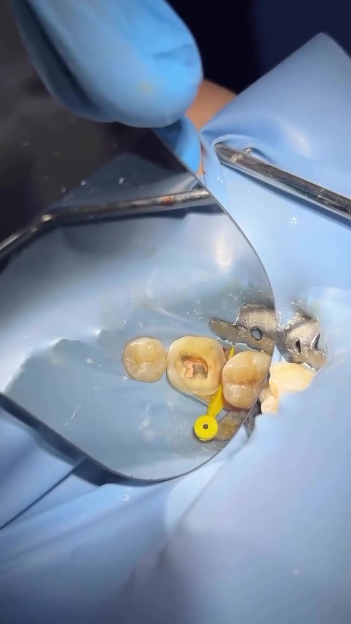 🦷 إعلان لأهل المنطقة 🦷
إذا تحتاجون أي علاج أسنان أو استشارة، تفضلوا بزيارة العيادة.

✅ تنظيف الأسنان
✅ حشوات تجميلية
✅ قلع الأسنان
✅ علاج العصب
✅ تركيبات وتلبيسات
✅ متابعة جميع حالات الأسنان

التعامل باهتمام وراحة للمريض، وأسعار مناسبة.

للاستفسار أو الحجز راسلوني على الخاص***********
، وأهلاً وسهلاً بالجميع. 🌹
