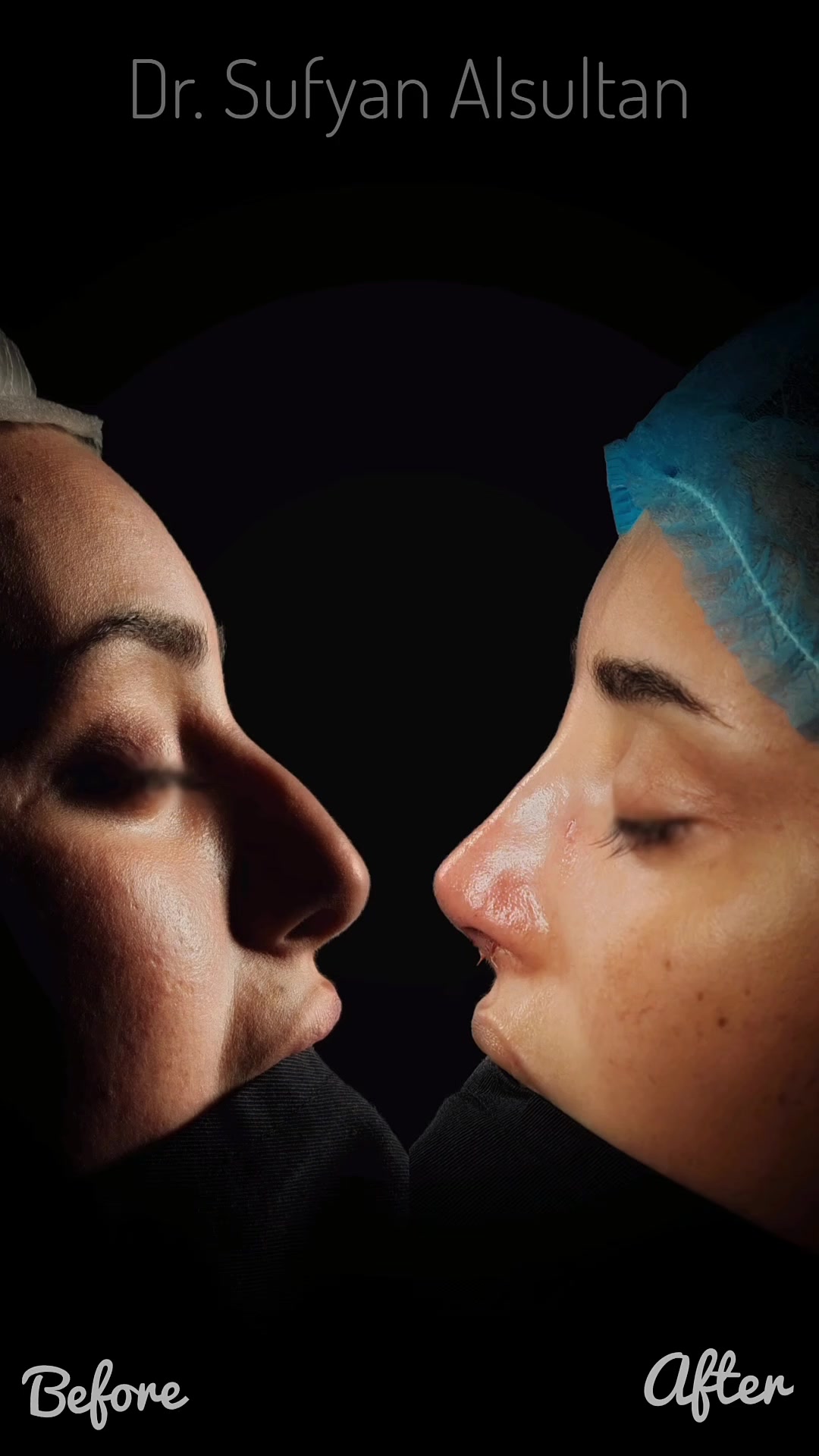 🔹 النتيجة مباشرة بعد العملية 👃✨
هذه الصور تُظهر النتيجة الفورية بعد عملية تجميل الأنف الوظيفي.

المريضة كانت تعاني من انسداد أنفي كامل 😮‍💨
بسبب انحراف الوتيرة مع تضخم الرفوف الأنفية.

⚠️ التحدي في هذه الحالة لم يكن الانسداد فقط،
بل أيضًا:
🧬 جلد رقيق (Thin skin)
🏗️ ضعف واضح في دعم مقدمة الأنف
في مثل هذه الحالات، أي تفصيل صغير يكون ظاهرًا،
لذلك يعتمد النجاح على 🎯 بناء دعم دقيق ومتوازن للطرف الأنفي
مع الحفاظ على شكل طبيعي بدون مبالغة أو مظهر مصطنع.
ما نراه الآن هو نتيجة أولية ⏳
مع تورم واحمرار متوقعين،
والتحسّن سيستمر تدريجيًا خلال الأشهر القادمة
من حيث التنفس 🌬️ والشكل 👌 معًا.
🔹 الجراحة الناجحة تُصلح الوظيفة وتحترم الملامح.

د. سفيان السلطان
جراحة الأنف والأذن والحنجرة
تجميل الأنف الوظيفي

