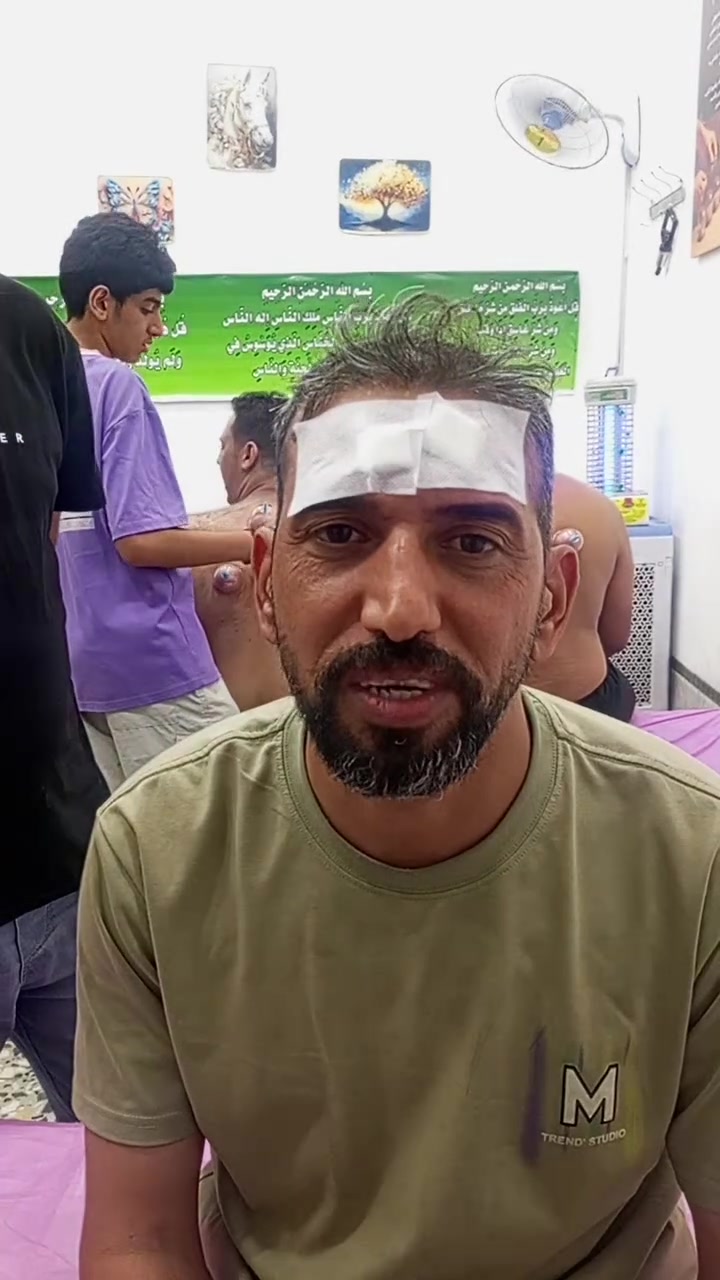 علاج الجيوب الأنفية • العلق الطبي • من اول جلسة