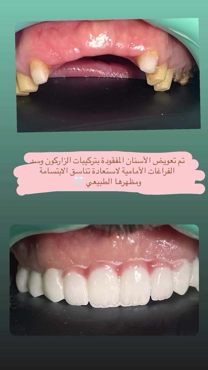 مركز بلاتينيوم كلينك الطبي 📍 بغداد –  المحمودية _حي 17 مجاور منفذ كرار الطائي 
📞 للحجز والاستفسار ***********
***********]#العالمي #الاكسبلور #بغداد_بصرة_موصل_الكويت_الخليج_دبي_الامارات_السعودية_العراق_حلوات_لبنان_سوريا_فلسطين #العراق #سليمانية

