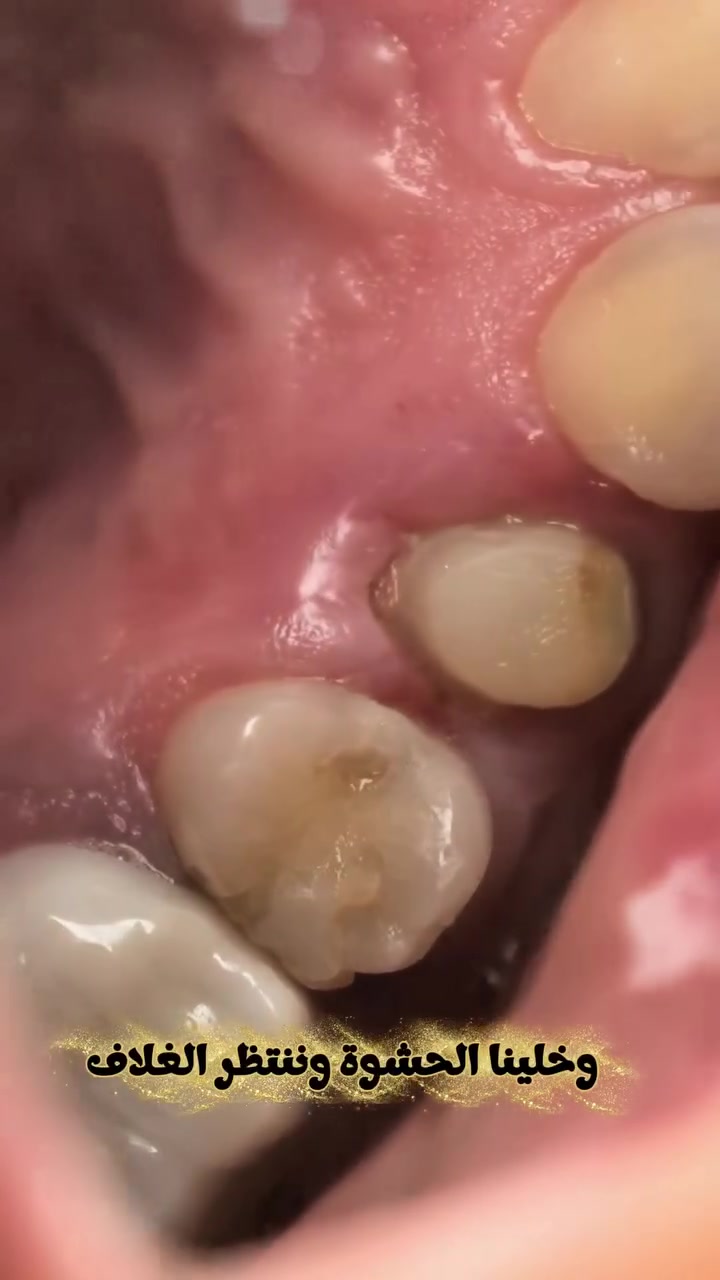 اذا محتاج دكتور اسنان يشتغلك اسنانك بدقه ونتيجة مضمونة وانسب الاسعار
راسلني
اني دكتَور يوسف متواجد بعيادة الافضل لطب الاسنان
عنوان العيادة/حي الرسالة _شارع الضغط _مجاور افران السوداني
*********** هذا رقمي للحجز
