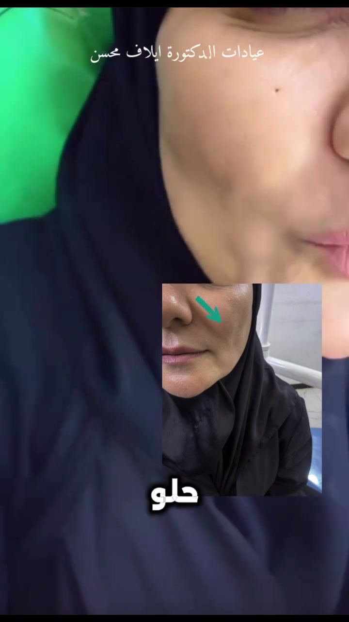 بوتوكس • تخفيف التجاعيد • حجز موعد