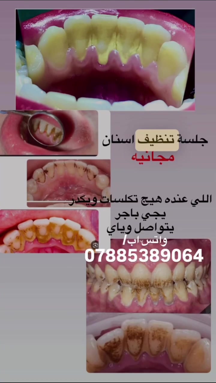 جلسة تنظيف اسنان
مجانيه
اللي عنده هيج تكلسات ويكدر
يجي باجر
يتواصل وياي
واتس اب/
***********
