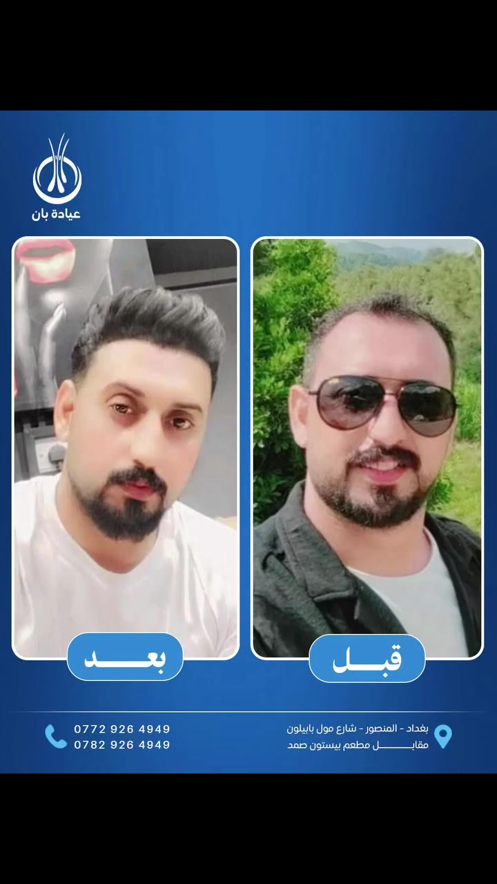 إذا_اتريد_تغير_حياتك_اليوم_وقتك_تاخذ_القرار_الصح
 👍

#حلمك_بحاجب_كثيف_صار_واقع  🥰

🌹بجلسه وحده ترجع ثقتك بنفسك وتعيش شبابك من جديد 

🌹مع عيادة بان موسى نقدم لكم كافة الامتيازات ♥️

🌹استغل عروض التخفيض الخاصة من عيادة بان موسى لزراعة الشعر وابدأ #رحلة_التغيير_بثقة

#خصومات_مميزة  ✅️
#استشارة_مجانية  ✅️
#متابعة_دقيقة_بعد_الزراعة_بكل_المراحل  ✅️

🔷️🕐 احجز الآن وابدأ التغير الحقيقي 
#ثقتك_بنفسك_تبدأ_من_شعرك 💪
 

🔥🔥 عــرض خــاص🔥🔥 

✅️عرض التخفيض الذهبي

                   👇 العـــرض يشـــمل  👇

#كادر_طبي_محترف_وزراعة_شعر_مضمونة
🔷️ ️10 بلازما + 10 ميزو ثيرابي للشعر 💉
🔷️ 4 جلسات بلازما ( تبيض ونضاره للبشره) 
🔷️ حقيبة علاجية متكامله 💊
🔷️ تحاليل وفحوصات قبل العمليه مجاني 
🔷️ العناية بشعر وغسلات مجانيه 🚿
🔷️ معاينه مجانيه لمدة سنة داخل العياده 
🔷️ التخدير بنج موضعي بدون الم 
🔷️ شهادة ضمان مدى الحياة على نجاح العمليه والكثافه 📜

✅️🔥 يتوفر عرض الاقساط 💸
🔷️ القسط الشهري وبدون مقدمه
🔷️ لحاملي بطاقة الماستر كارد الرافدين حصراً
🔷️ استقطاع الكتروني
🔷️ لجميع الموظفين والمتقاعدين وابطال وزارة الداخلية والدفاع 

✅️🔥 ويوجد لدينا ايضا🥇عرض الملكي ...(ViP)💰 

🔷️العنوان📍بغداد/ المنصور / مقابل مطعم بيستون صمد / عمارة سترونگ/ الطابق الرابع 

🔷️للحجز و الاستفسار التواصـل خاص او على الأرقام التالية ☎️📞

***********
***********
***********
