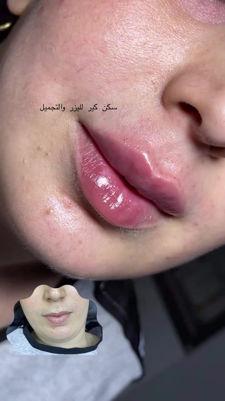 💋✨ عرض الشفايف الفرنسي ✨💋

دلّلي شفايفج بلمسة ناعمة وأنيقة 💕
فلر شفايف فرنسي 🇫🇷
بس بـ 50 ألف فقط! 🔥

نعومة • امتلاء • تحديد أجمل 💖
لأن جمالج يستاهل لمسة فرنسية راقية ✨

📍 سكن كير لليزر والتجميل
📞 ***********
🌸 العرض لفترة محدودة 🌸
#حقن #جلديه #اكسبلور_explore #اكسبلور_فولو #تصبغات
