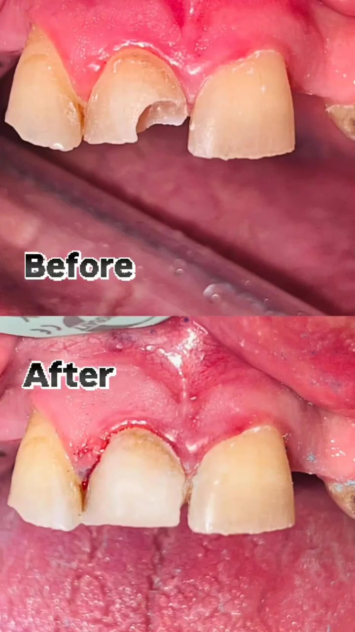 حشوات التجميلة بعيادتنه عياده لارين 😍
خان بني سعد مجمع الطبي عياده لارين 

. الحجز والاستفسار ***********

#اكسبلور
#ترند
#foryou
#fyp
#اسنان
#الجميع
