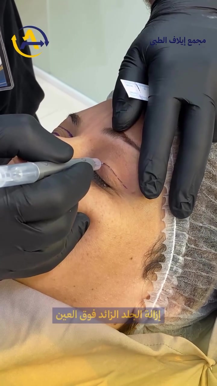✨ نظرة أكثر إشراقاً… بلمسة جراحية دقيقة 👁️🤍

عملية قص الأجفان العلوية والسفلية تساعد على التخلص من الجلد والدهون الزائدة حول العين لتمنح العينين مظهراً جميلاً مع الحفاظ على طبيعة ملامح الوجه ✨

لأن جمالك الحقيقي لا يحتاج إلى تغيير ملامحك…
بل إلى إبراز أجمل تفاصيلك 🌿😍

👁️ قص الأجفان العلوية والسفلية
دقة في التفاصيل… ونتيجة أكثر تناسقاً ✨
الدكتور: أوميد محمد مصطفى 
‏أخصائي جراحة الوجه والفكين

📩 للاستفسار وحجز موعد، تواصل معنا الآن.

🏥 مجمع إيلاف الطبي
📍 خانقين – شارع البريد – قرب مول تفاح الأخضر

📩 للاستفسار والحجز تواصلوا معنا:
📞 ***********
📞 ***********

#مجمع_إيلاف_الطبي #خانقين 
#قص_الأجفان #تجميل_الأجفان #تجميل_العيون
