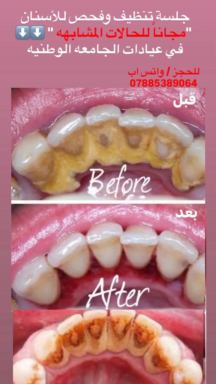 جلسة تنظيف اسنان للحالات المشابهه مجاناً‼️‼️
