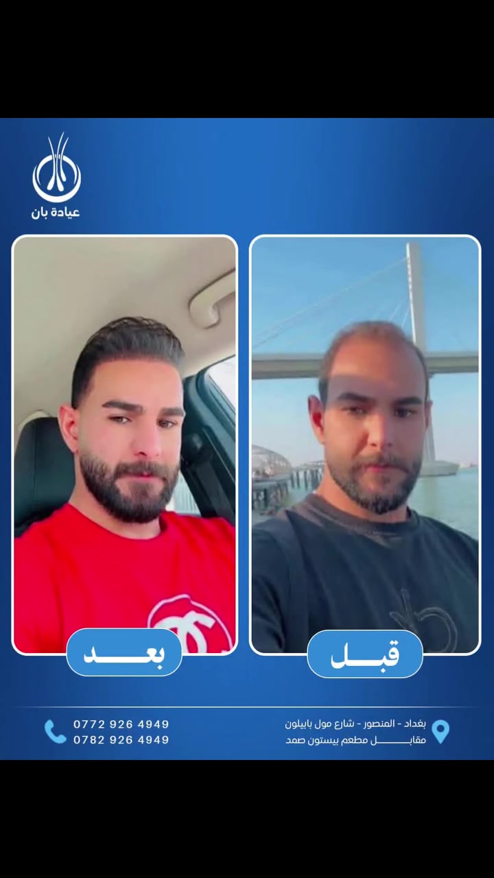 إذا_اتريد_تغير_حياتك_اليوم_وقتك_تاخذ_القرار_الصح
 👍

#حلمك_بحاجب_كثيف_صار_واقع  🥰

🌹بجلسه وحده ترجع ثقتك بنفسك وتعيش شبابك من جديد 

🌹مع عيادة بان موسى نقدم لكم كافة الامتيازات ♥️

🌹استغل عروض التخفيض الخاصة من عيادة بان موسى لزراعة الشعر وابدأ #رحلة_التغيير_بثقة

#خصومات_مميزة  ✅️
#استشارة_مجانية  ✅️
#متابعة_دقيقة_بعد_الزراعة_بكل_المراحل  ✅️

🔷️🕐 احجز الآن وابدأ التغير الحقيقي 
#ثقتك_بنفسك_تبدأ_من_شعرك 💪
 

🔥🔥 عــرض خــاص🔥🔥 

✅️عرض التخفيض الذهبي

                   👇 العـــرض يشـــمل  👇

#كادر_طبي_محترف_وزراعة_شعر_مضمونة
🔷️ ️10 بلازما + 10 ميزو ثيرابي للشعر 💉
🔷️ 4 جلسات بلازما ( تبيض ونضاره للبشره) 
🔷️ حقيبة علاجية متكامله 💊
🔷️ تحاليل وفحوصات قبل العمليه مجاني 
🔷️ العناية بشعر وغسلات مجانيه 🚿
🔷️ معاينه مجانيه لمدة سنة داخل العياده 
🔷️ التخدير بنج موضعي بدون الم 
🔷️ شهادة ضمان مدى الحياة على نجاح العمليه والكثافه 📜

✅️🔥 يتوفر عرض الاقساط 💸
🔷️ القسط الشهري وبدون مقدمه
🔷️ لحاملي بطاقة الماستر كارد الرافدين حصراً
🔷️ استقطاع الكتروني
🔷️ لجميع الموظفين والمتقاعدين وابطال وزارة الداخلية والدفاع 

✅️🔥 ويوجد لدينا ايضا🥇عرض الملكي ...(ViP)💰 

🔷️العنوان📍بغداد/ المنصور / مقابل مطعم بيستون صمد / عمارة سترونگ/ الطابق الرابع 

🔷️للحجز و الاستفسار التواصـل خاص او على الأرقام التالية ☎️📞

***********
***********
***********
