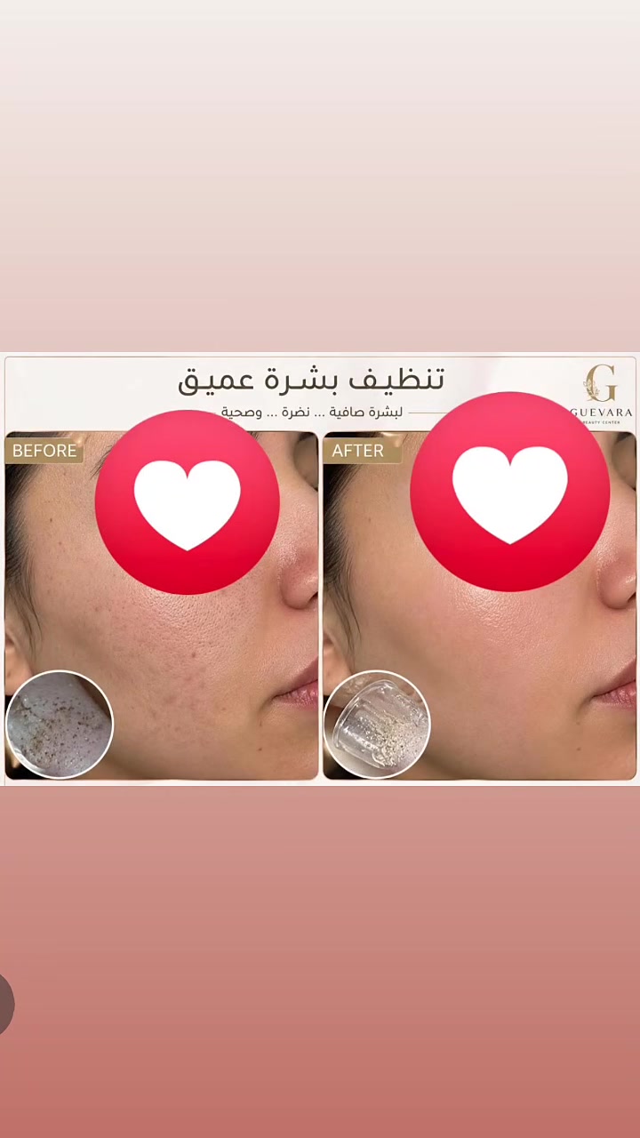 ✨ نشارككم جانباً من جلسات العناية بالبشرة التي نقدمها لزائراتنا الكريمات 💖

خلال جلسة تنظيف البشرة العميق يتم العمل على إزالة الشوائب وتنظيف المسام والعناية بالبشرة لمنحها مظهراً أكثر نضارة وإشراقاً ✨

نسعد دائماً بثقتكم، ونسعى لتقديم أفضل الخدمات بأحدث الأجهزة وأساليب العناية بالبشرة 🌷

📍 مجمع جيفارا الطبي
📍 جبلة – شارع الأطباء – مقابل عيادة الدكتور حميد الزيدي

📞 للحجز والاستفسار: ***********

💎 جمالكِ يبدأ ببشرة صحية ومشرقة.

#مجمع_جيفارا_الطبي #جبلة #شارع_الأطباء #العناية_بالبشرة #تنظيف_البشرة #هايدروفيشل #نضارة_البشرة #ليزر #تجميل #بابل #العراق #جمالك_مع_جيفارا ✨💖
