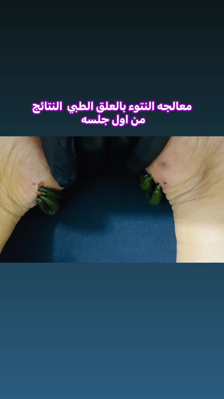 العلق الطبي • علاج الدوالي • النعمانية