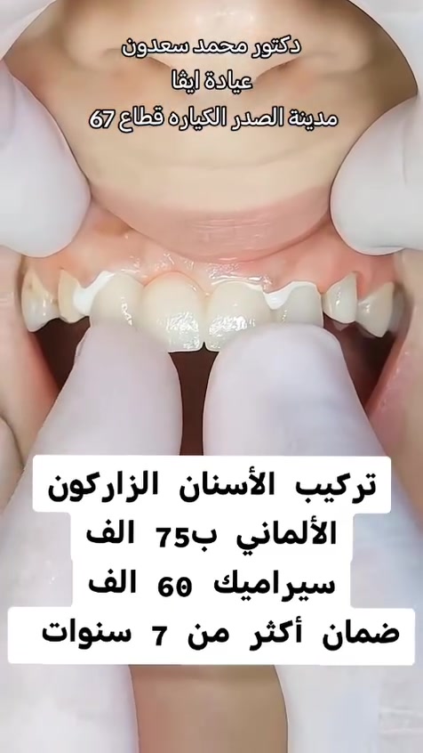 حشوه ضوئية تجميليه ب25 ألف
75 ألف تركيب الزاركون الألماني المدمج بالايماكس 
55 ألف تركيب السيراميك الألماني 
تقويم الاسنان بالتقسيط المريح 
زراعة الأسنان 

فحص ومعاينة مجاني يوميا مع اشعه للاسنان ☺️

عيادة ايفا للتجميل والأسنان 💉🦷
دكتوره شيماء احمد 
دكتور محمد سعدون 

العنوان #مدينة الصدر الكياره قطاع٦٧ مقابل نادي الجولان

‏‪***********‬‏📞
