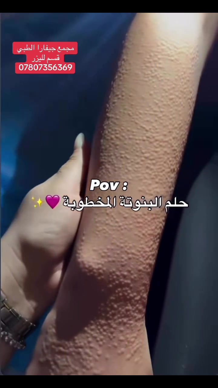 ✨ تعبتي من إزالة الشعر المتكررة؟ ✨
خلي راحتچ تبدأ من قسم الليزر في مركز جيفارا الطبي 🤍

🔥 إزالة شعر بفعالية وعناية
✨ أيدي كادر اختصاص
🧴 اهتمام بالنظافة والتعقيم
💎 أجهزة حديثة وتجربة مريحة
🌸 لأن جمالچ وراحتچ تهمنا

📍 جبلة – شارع الأطباء – مقابل عيادة الدكتور حميد الزيدي
📞 للحجز والاستفسار: ***********

جيـفارا الطبي… راحتچ أولاً 🤍

#مركز_جيفارا_الطبي #ليزر #ازالة_الشعر #ليزر_جبلة #جبلة #بابل #قسم_الليزر #عناية_وجمال #بشرة #ليزر_العراق #جمال_ونظافة

