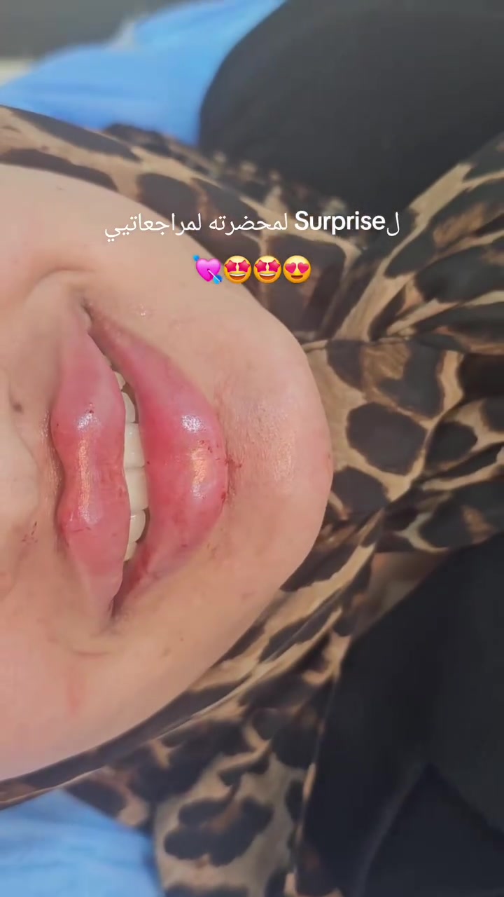 فلر الشفايف • شفايف ممتلئة • د. جعفرية عبد الرزاق