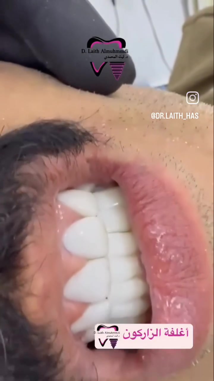 ✨🦷 ابتسامة الزركون… لأن ابتسامتك تستحق الأفضل 🦷✨
تمتعي بابتسامة جميلة وطبيعية مع أغلفة الزركون، التي تجمع بين القوة والجمال لتمنحك أسنانًا متناسقة ومشرقة 🤍

مميزات ابتسامة الزركون:
✨ مظهر طبيعي وجذاب
🦷 قوة ومتانة عالية
🤍 لون ثابت ولمعان مميز
😊 تمنحك الثقة بابتسامتك كل يوم

📍 العنوان: الفلوجة – الجغيفي الثانية، قرب الصيدلية المركزية، مقابل قاعة الجوهرة

👨‍⚕️ د. ليث المحمدي
📞 للحجز والاستفسار: ***********

ابتسامتك الجديدة تبدأ بخطوة… احجز موعدك الآن 🤍✨
