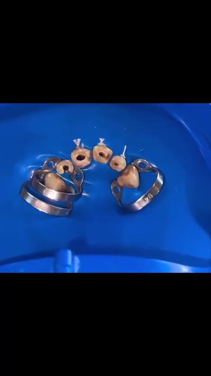 التغاليف الغلط تكلفك هواي.. والحل يم سما الفاو!
مو كل شي يلمع هو ابتسامة صحية! اختيارك للتغليف الخطأ أو المواد الرخيصة ممكن يكلفك صحة أسنانك، وقتك، وفلوسك أضعاف المرة الأولى.
بـ مركز سما الفاو الطبي للاسنان، ما نغطي المشكلة.. إحنا نحلها صح!
✨ تغاليف بمواصفات عالمية.
✨ دقة متناهية بالتركيب لحماية الأسنان الطبيعية.
✨ أطباء أخصائيين يضمنون إلك النتيجة المثالية من أول مرة.
لا تخاطر بابتسامتك.. احجز موعدك وتأكد إنك بالمكان الصح! 🦷✨

العنوان البصره قضاء الفاو - سوق الفاو الجديد - مجمع الجهاد الطبي الطابق الثاني - فوق عياده د عادل عطيه .
الرقم / ***********
#ابتسامة_هوليود #الفاو #حشوات #ابتسامة #زراعة_اسنان ابتسامة_المشاهير
