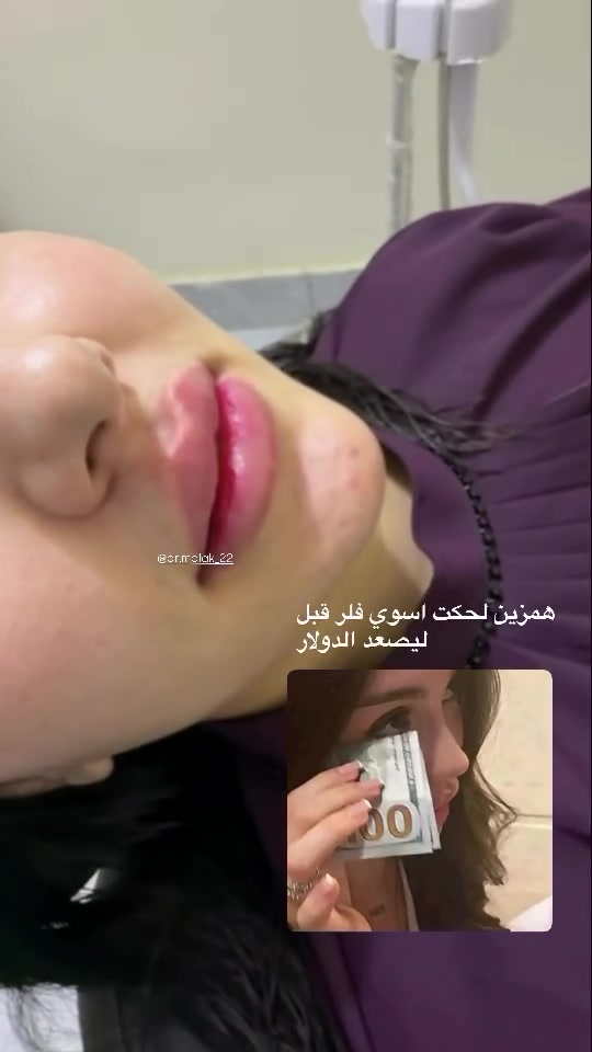 فيلر شفايف • مواد أصلية • عيادة أسنان