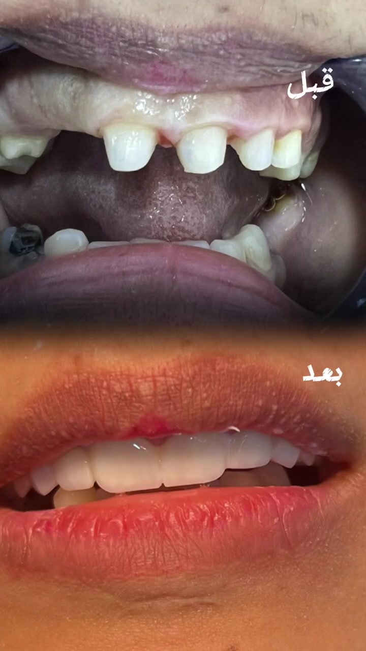 تغيير الابتسامة بتغليفات الزركون الطبيعي ✨🦷
ابتسامة جديدة بتناسق طبيعي، شكل أنيق ولون قريب من الأسنان الطبيعية.
احجز موعدك الآن وابدأ رحلة ابتسامتك الجديدة 🤍***********
***********
