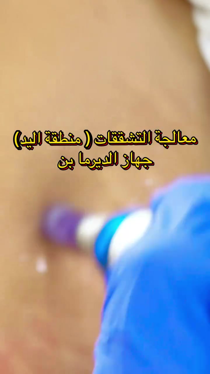 تشققات اليدين • ديرمابن • مركز الهدى