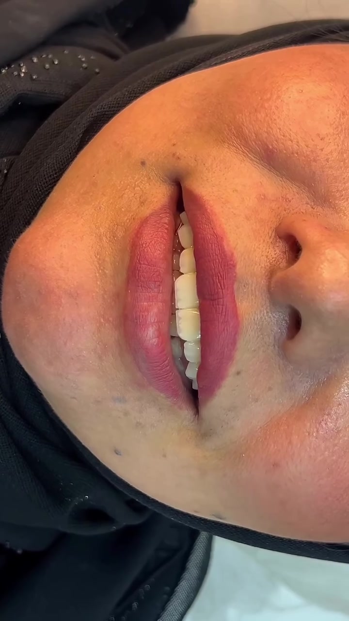 � مو كل ابتسامة حلوة… لازم تكون طبيعية!

✨ ابتسامة زاركون أو E-max
لجمال أنيق، شكل طبيعي، وتناسق يليق بملامح وجهك .

