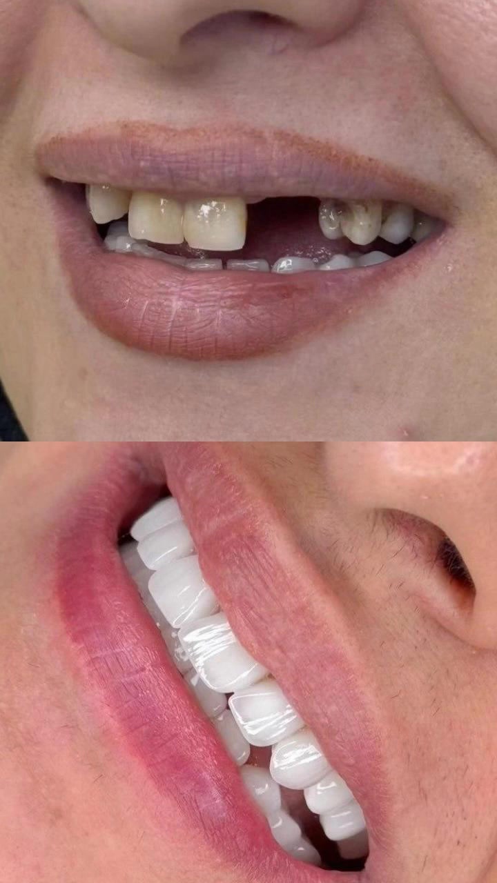 تجميل أسنان • تلبيس أسنان • القرنة