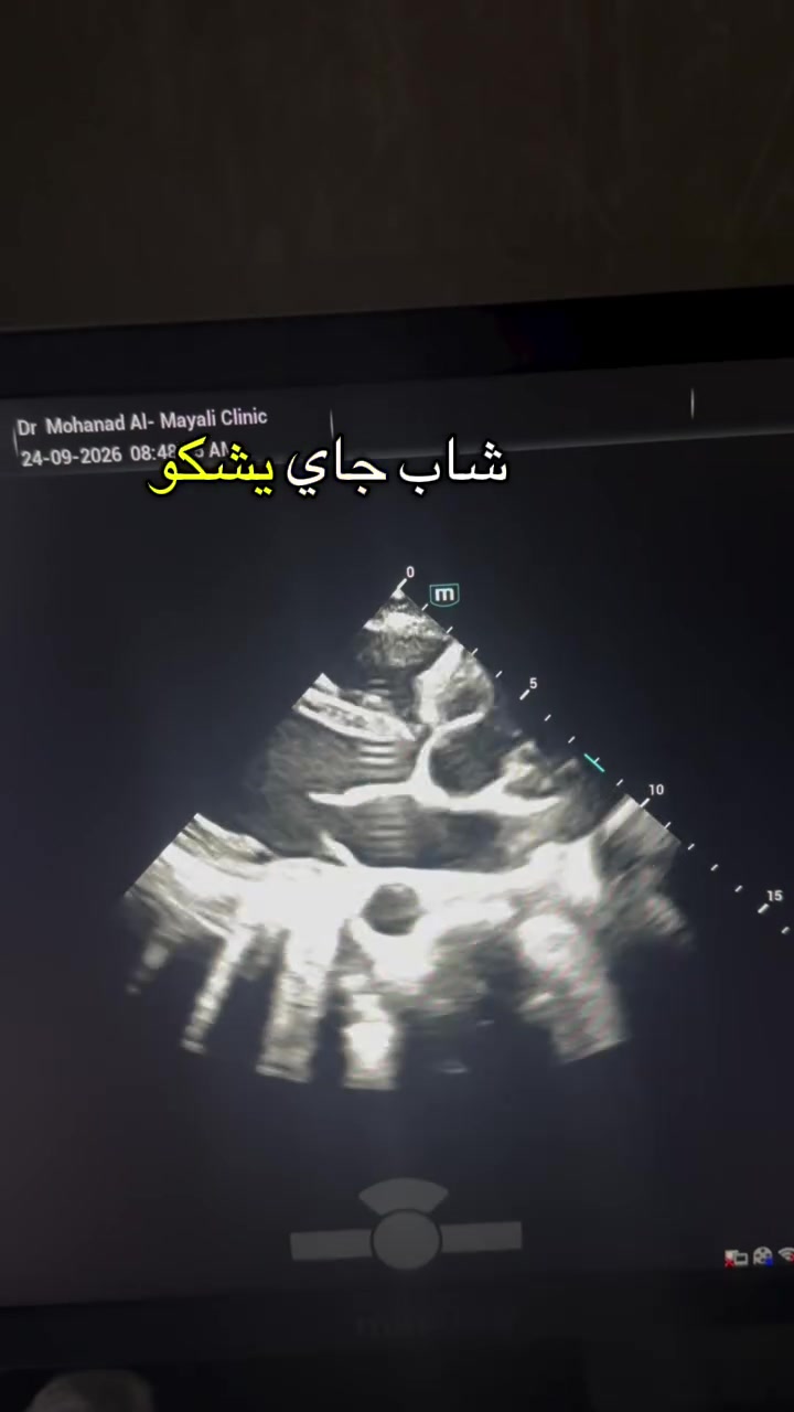 قلبك يستحق أن تطمئن عليه… قبل أن يُنذرك!

شاب، بصحة جيدة، ولا يعاني من أعراض واضحة… لكنه قرر أن يتأكد من صحة قلبه.
🫀 وكانت الخطوة: فحص القلب بجهاز الإيكو (Echocardiography).

الإيكو يساعد الطبيب على تقييم:
✔️ قوة عضلة القلب
✔️ صمامات القلب
✔️ حجم حجرات القلب
✔️ حركة عضلة القلب
✔️ وجود بعض المشاكل القلبية التي قد لا تظهر بأعراض واضحة

لا تنتظر ظهور الأعراض حتى تهتم بقلبك.
الفحص المبكر والاطمئنان جزء من 
الوقاية ❤️

في عيادتنا… نضع صحة قلبك أولاً.
📞 للحجز والاستفسار: تواصلوا معنا عبر الرسائل أو الاتصال

***********

العنوان / الحمزة الشرقي -شارع الاطباء -عيادة د مهند الميالي
