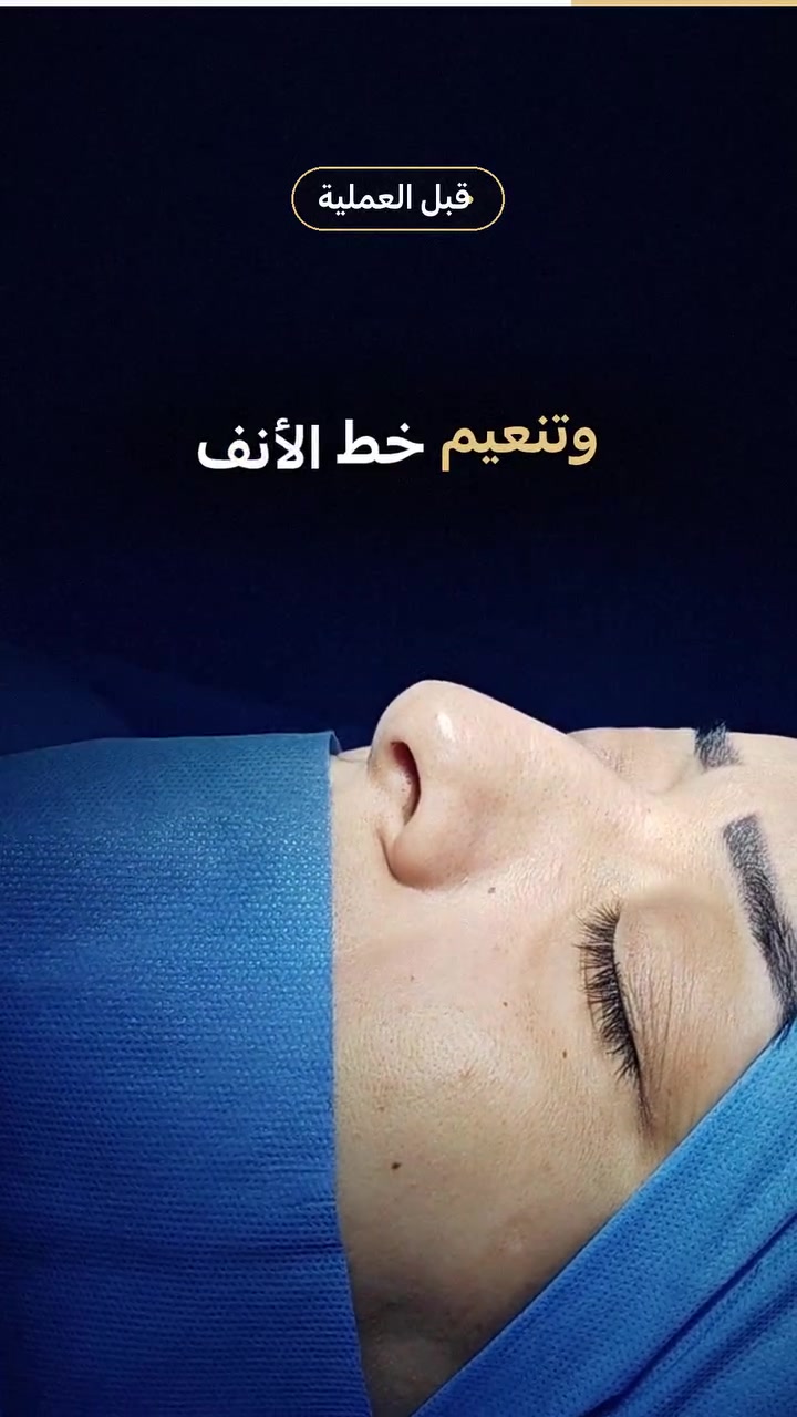 تجميل أنف • العزيزية واسط • د. وئام جابر