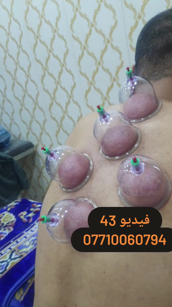 (فيديو جلسة حجامة) 43
العنوان بغداد_الكرخ الجعيفر_شارع الشيخ معروف قرب جامع رشيد دراغ
الحجز او الاستفسار ***********
 #طب_تكميلي #حجامة_رياضية #حجامةالطائي #مركزحجامةالكرخ

